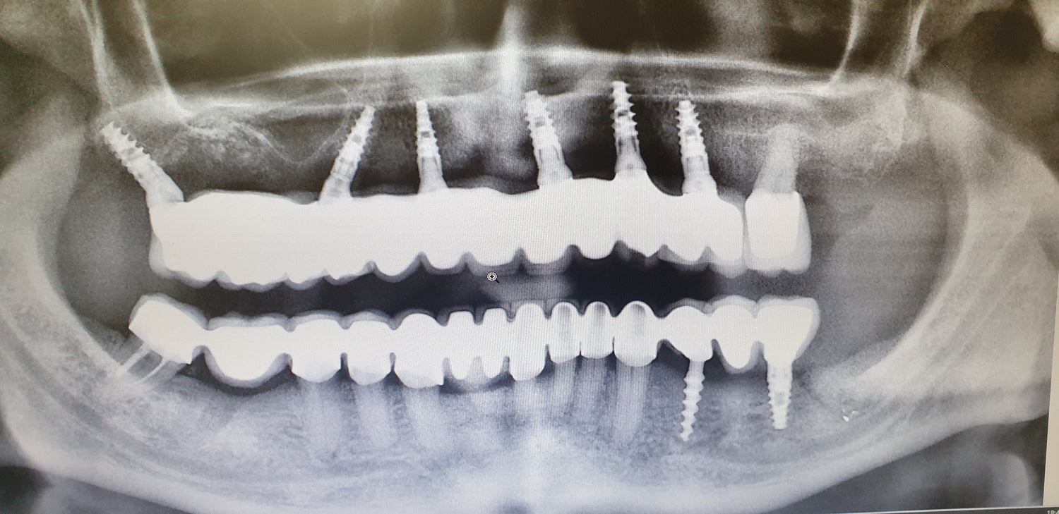 Clinical Case: 8 GDT Dental Implants Oral Surgery
