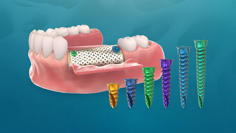 Optimizing Bone Regeneration: Ensuring Stability with GDT GBR Bone Screws