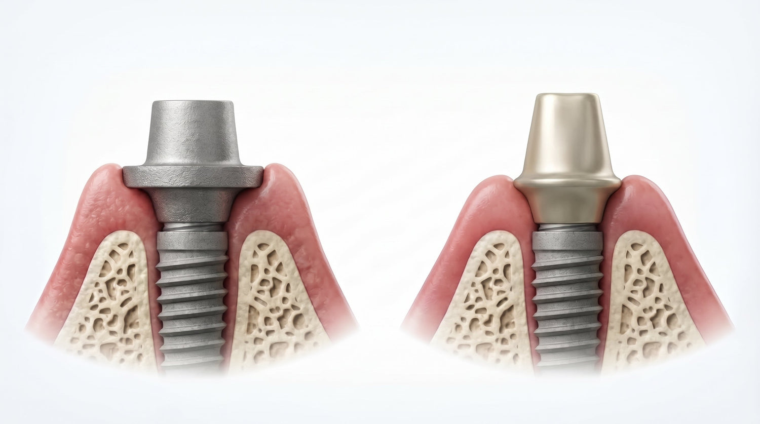Healing Abutment vs Final Abutment