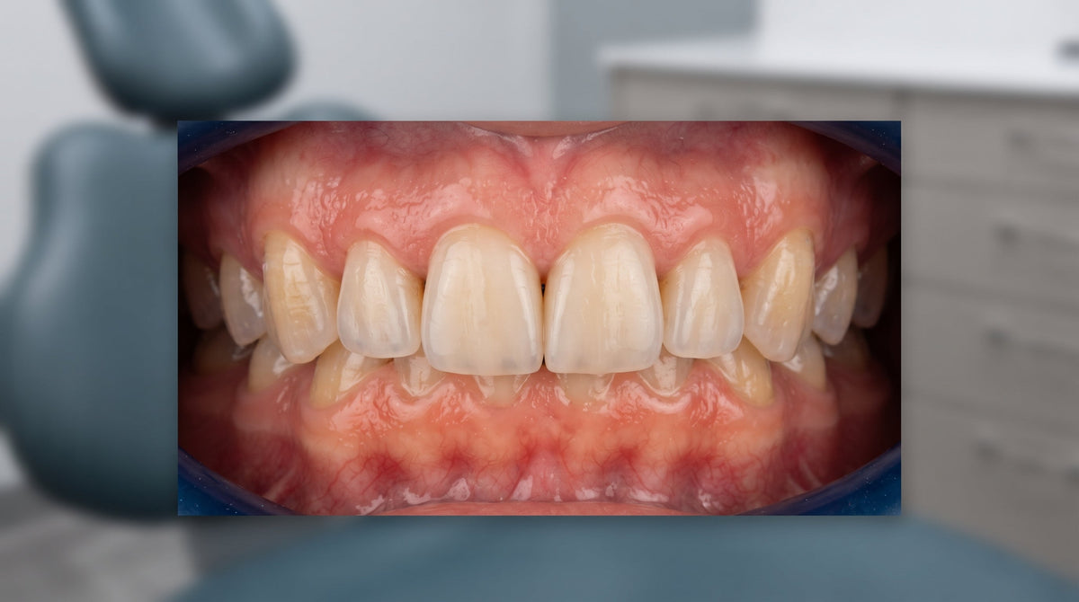 Soft Gums Around Implants