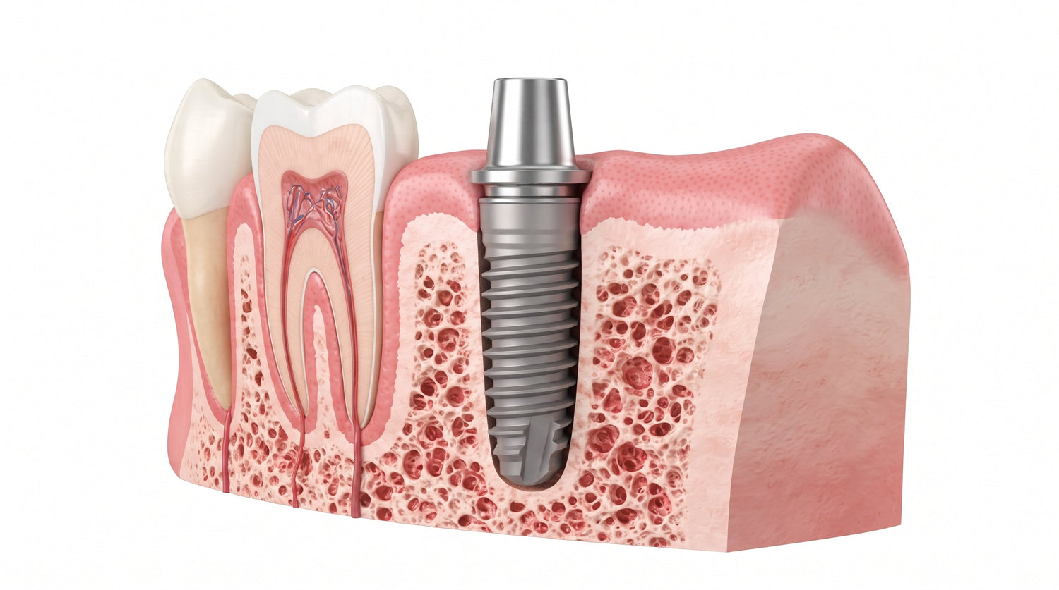 How Long for Implant to Heal Before Crown