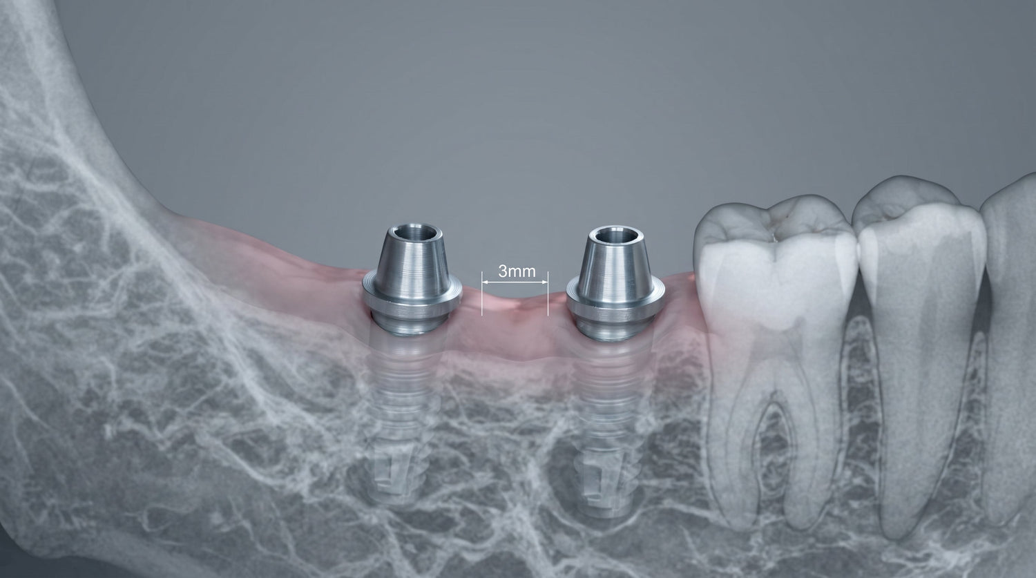 Distance Between Implants