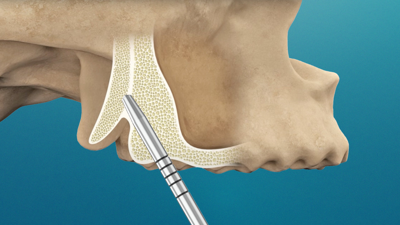 Pterygoid Bone Osteotomes - GDT Dental Implants