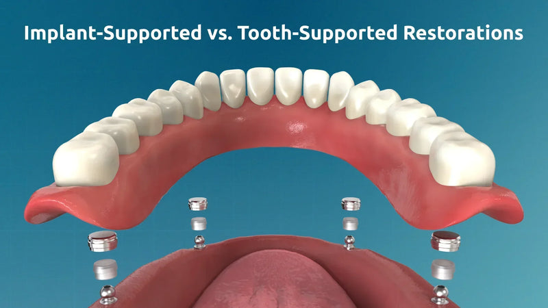 3D rendering showing a full arch dental prosthesis supported by implants, positioned above the edentulous mandibular ridge with visible implant abutments.