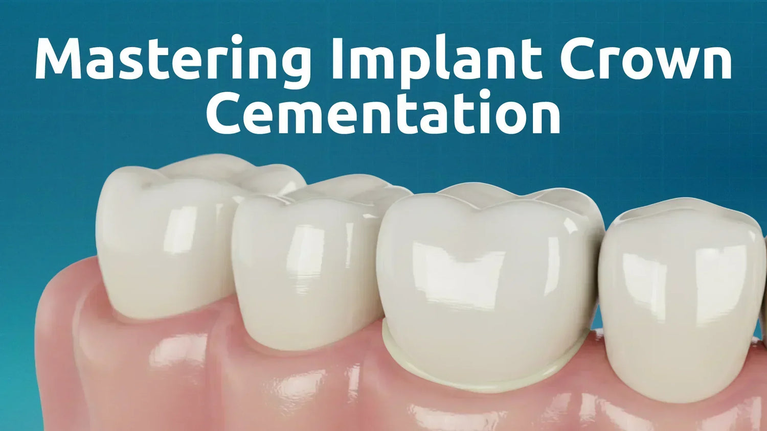 Mastering Implant Crown Cementation: Why Dual-Cure Temporary Cements Offer a Clinical Advantage