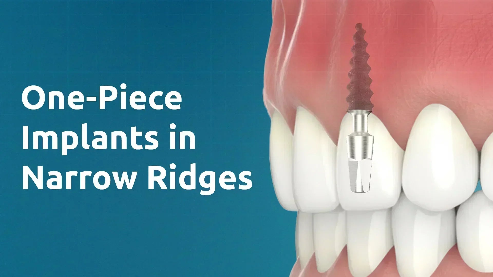 One-Piece Implants in Narrow Ridges: Clinical Indications and Surgical