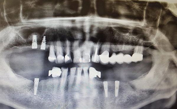 Clinical Case: Sinus Lifting - with GDT Spiral Dental Implants & Bone Graft