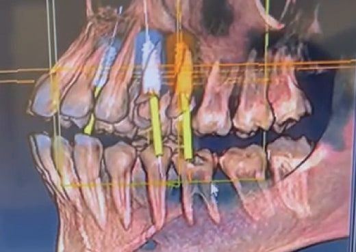 Clinical Case  X-ray image of Posterior Teeth Replacement with GDT Dental Implants on both sides of the Maxilla