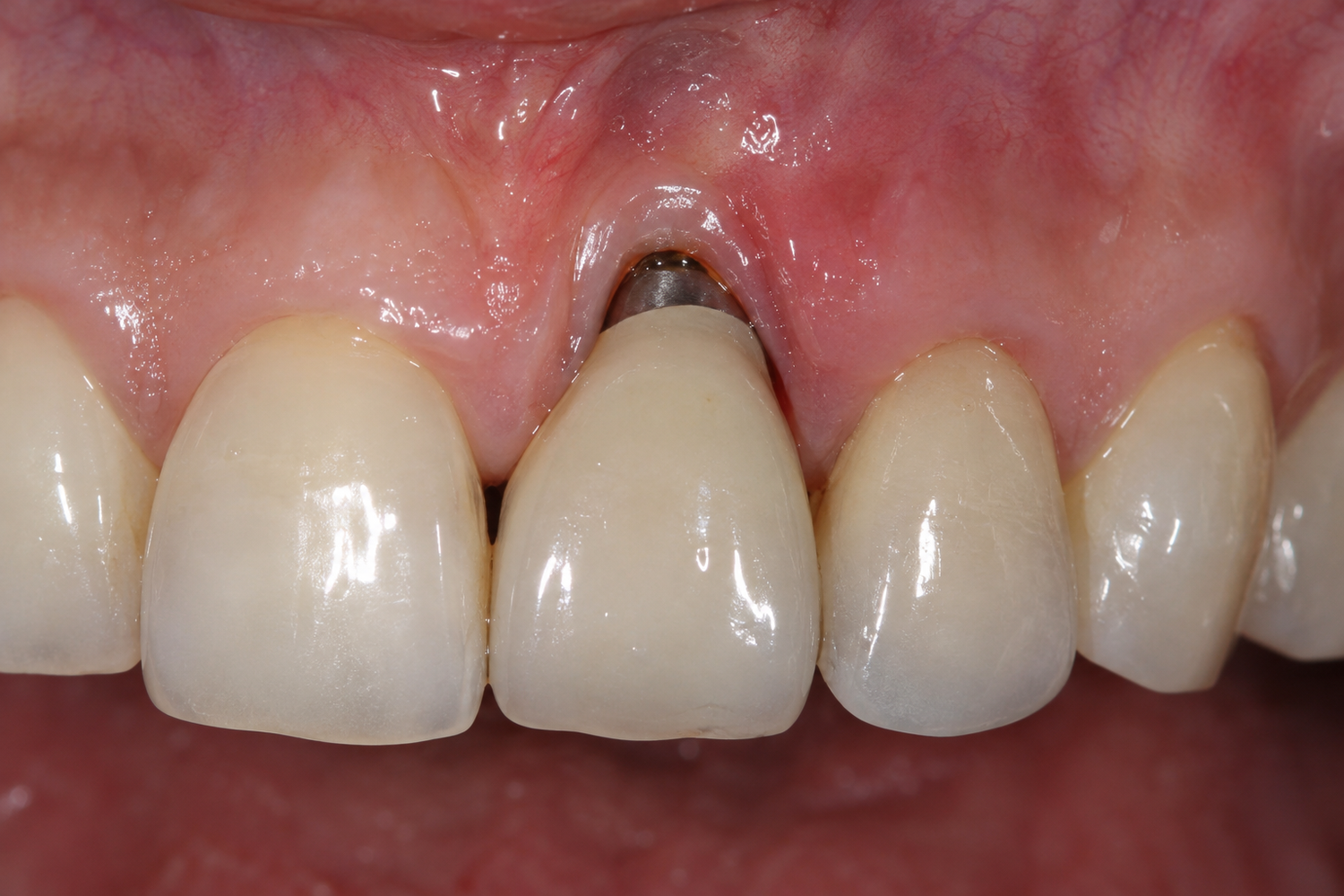 Recession Dental Around Implants