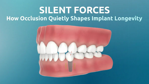 3D illustration of a gdt dental implant under occlusal load with arrows showing force direction in the jaw, representing how bite forces influence implant longevity. Banner text reads “Silent Forces: How Occlusion Quietly Shapes Implant Longevity.