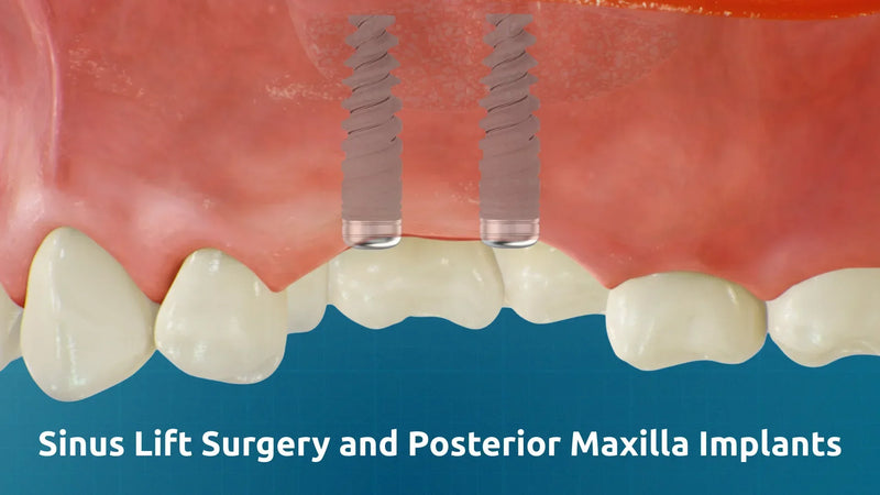 3D medical illustration showing two dental implants placed in the posterior maxilla region following sinus lift surgery.