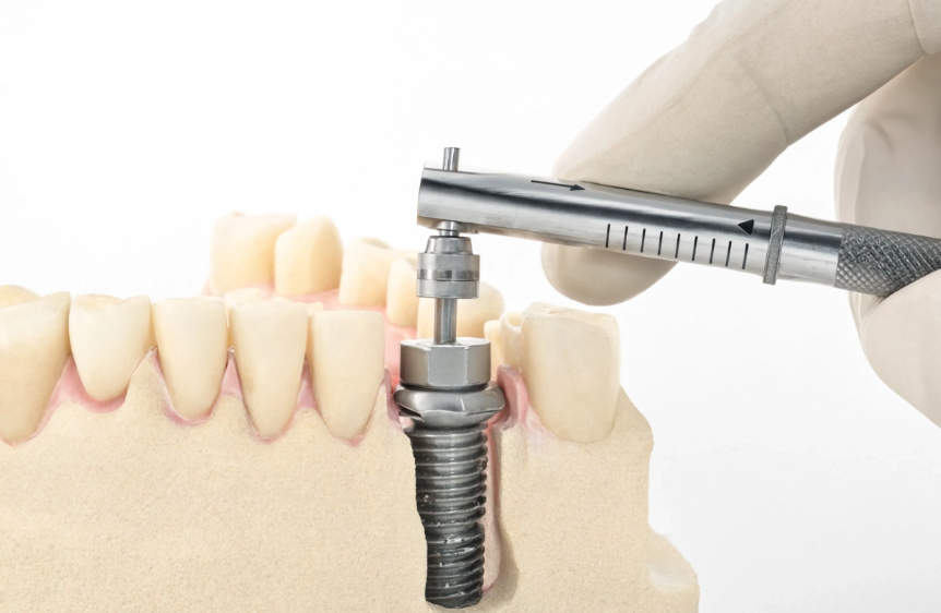 How to Torque an Implant Abutment