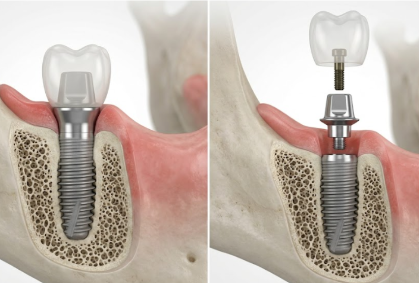 one-piece vs two-piece implant