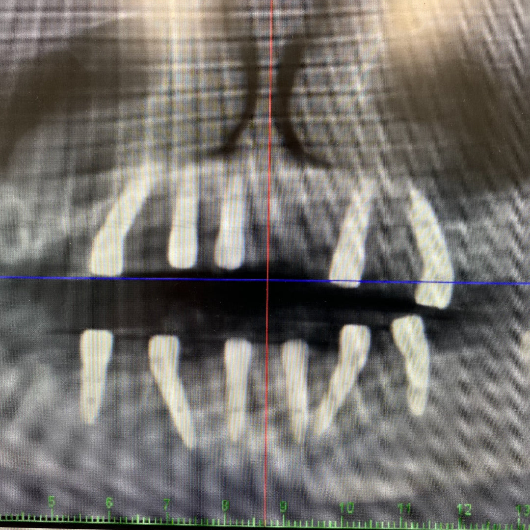 x ray of full-Arch Rehabilitation using GDT Multi-unit abutments