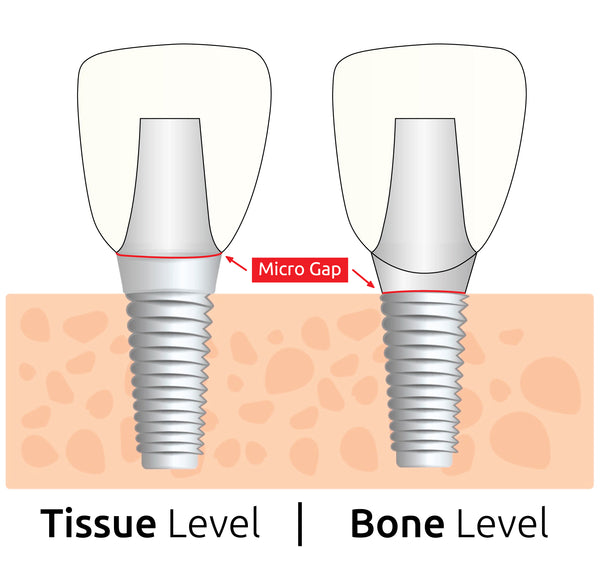 Illustration of Bone-level and Tissue-level dental implants