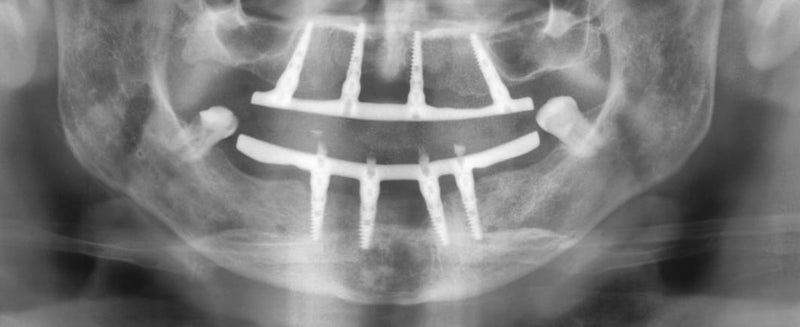 Clinical Case: Immediate Full-Arch-on-Four Rehabilitation with GDT RBM Implants