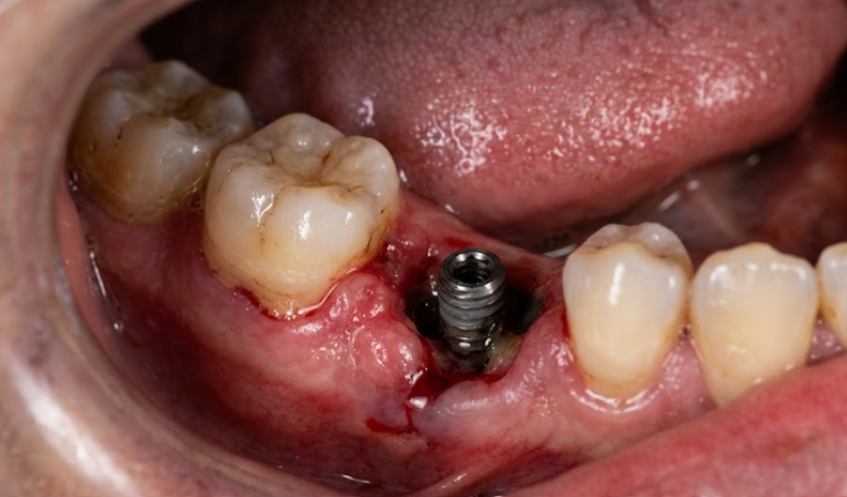 what is dental implant failure