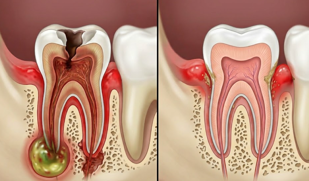 Dental Infection VS Inflammation