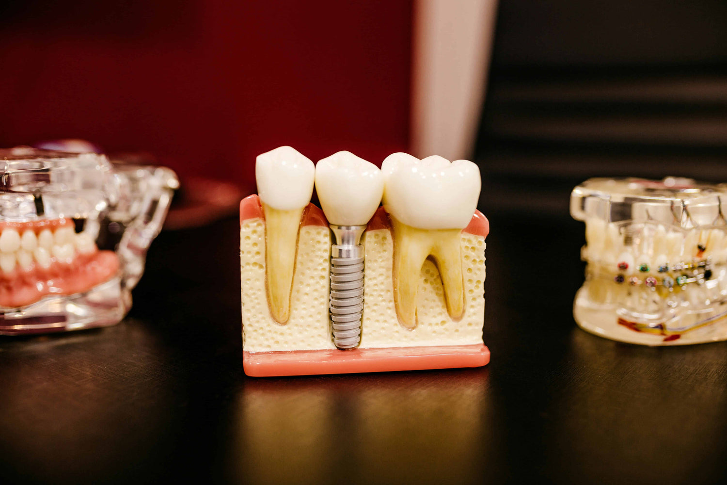 Dental Implants Titanium VS Zirconium