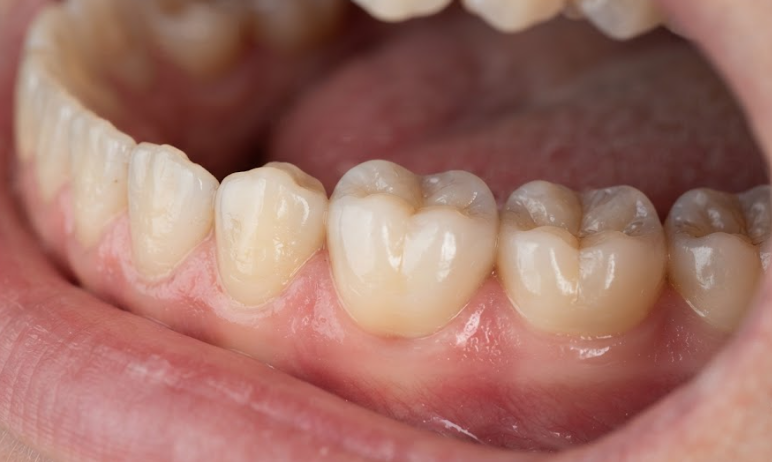 what is dental implant restoration