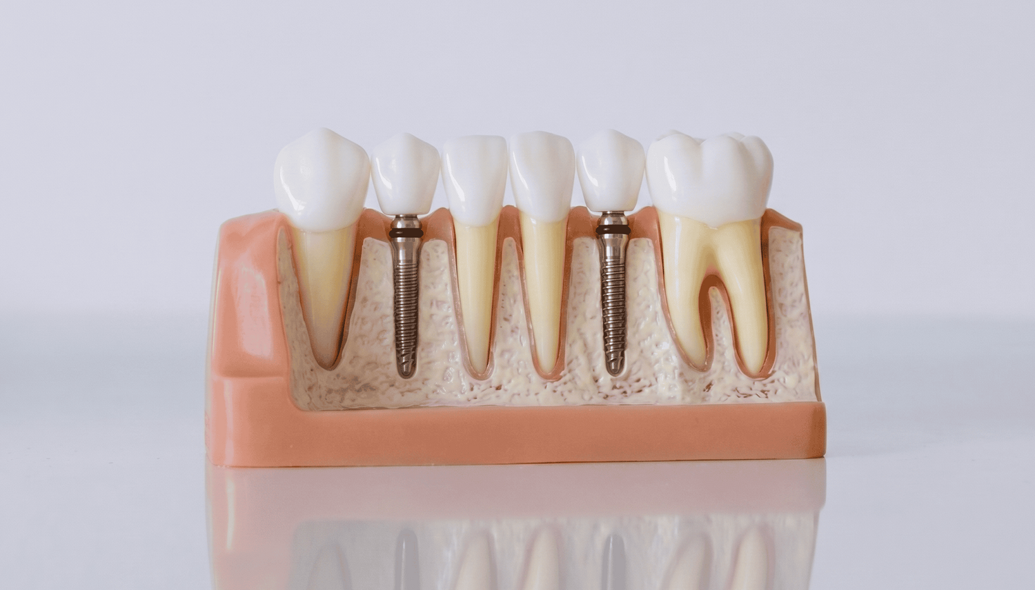 Mini Or Small Dental Implants
