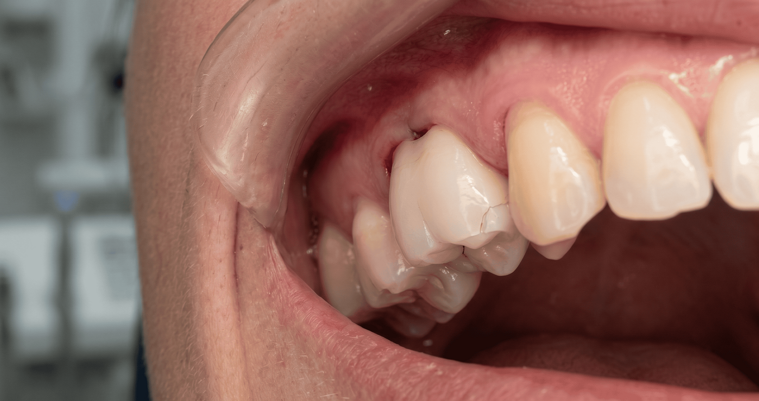 Zirconia Crowns Problems