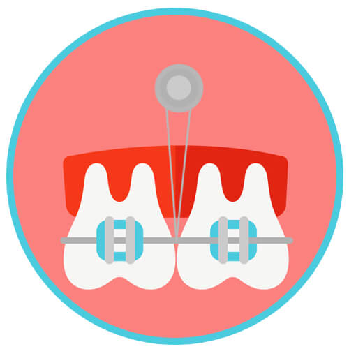 Orthodontic Micro-Implants (TADs)